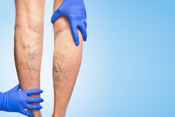 Fort Worth Heart Services - Vein Therapy
